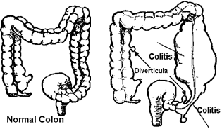 colon comparison